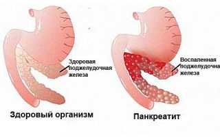 Отечный панкреатит, острая и хроническая форма