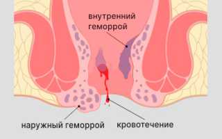 Острая сильная резкая боль при геморрое, что делать?