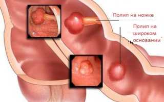 Полипы толстого кишечника