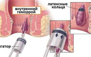 Лигирование геморроидальных узлов латексными кольцами, лечение наружного и внутреннего геморроя лигатором