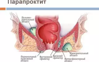 Проктит и парапроктит