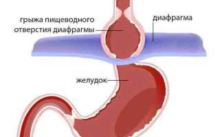 Грыжа пищеводного отверстия диафрагмы (ГПОД)