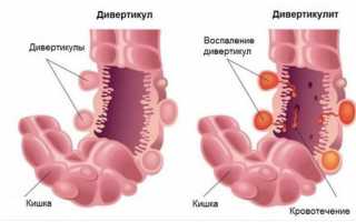 Операция по удалению дивертикула кишечника