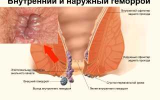 Геморрой у женщин, с чего начинается, как выглядит и диагностируется?