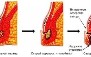 Начальная стадия парапроктита