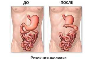 Последствия и лечение рака желудка после операции