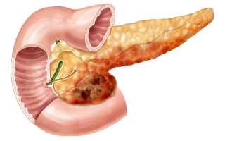 Лечение панкреатита (поджелудочной железы) в санатории и на курорте