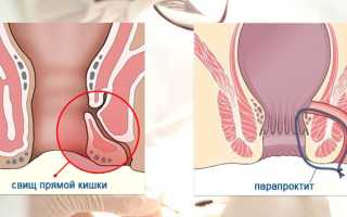 Хронический парапроктит