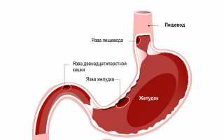 Что такое хронический гастродуоденит?