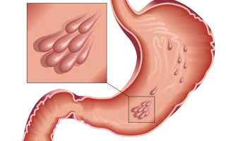 Причины полипов в желудке