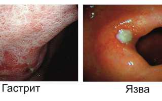 Прижигание язвы желудка лазером как один из методов лечения