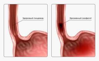 Симптомы и лечение эрозивного эзофагита