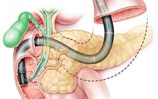 Зондирование поджелудочной железы