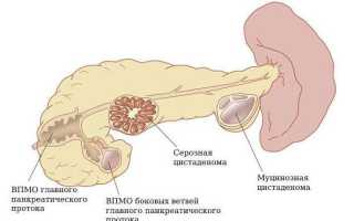 Что такое псевдокиста поджелудочной железы, какие симптомы и лечение?