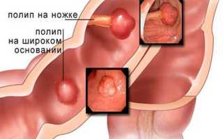 Симптомы и лечение полипов в толстой кишке