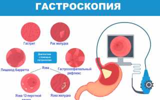 Постановка диагноза атрофического гастрита