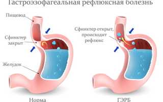 Катаральный (поверхностный) эзофагит нижней трети пищевода