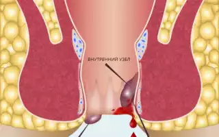 Чем лечить кровотечение при геморрое?