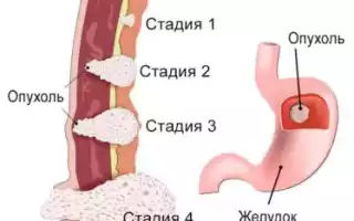 Рак желудка 2 (второй) степени