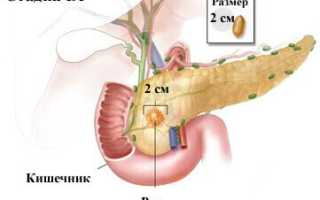 Рак поджелудочной железы 1-2-3-4 стадии (степени)