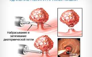 Как производится удаление полипов?