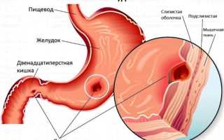 Немая язва желудка и ее симптомы