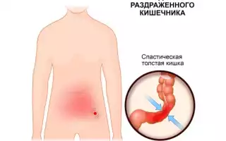 Обострение СРК (синдрома раздражённого кишечника)