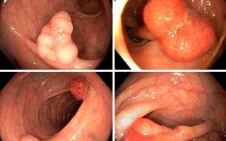 Лечение после удаления полипов