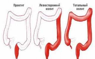 Тотальный язвенный колит