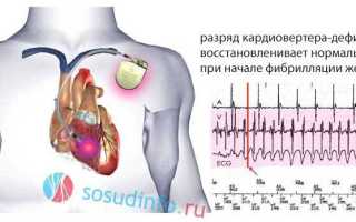 Crt d трехкамерный кардиовертер дефибриллятор