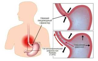 Кашель при эзофагите