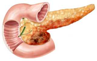 Перитонит поджелудочной железы при панкреатите и панкреонекрозе