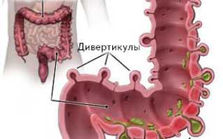 Симптомы и лечение дивертикулёза кишечника