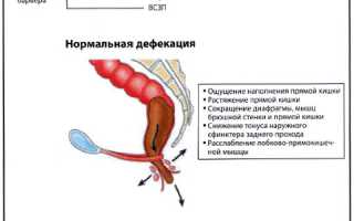 Механизм запора, что происходит во время него в кишечнике?