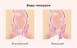 Геморрой у беременной женщины, геморроидальные узлы у беременных женщин