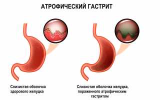 Атрофический рефлюкс-гастрит