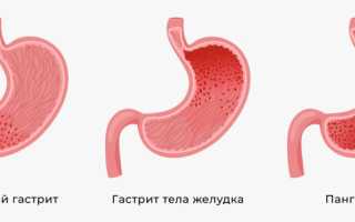 Лечение гастрита антрального отдела желудка