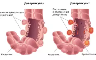 Дивертикулёз тонкого кишечника симптомы