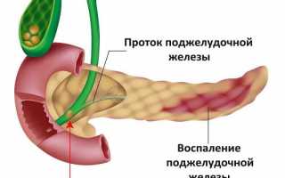 Патология поджелудочной железы