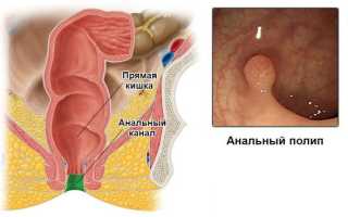 Анальный полип – признаки, причины появления, особенности лечения