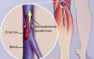 Механизм образования белого тромба