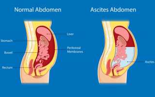 Асцит при раке желудка