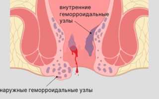 Может ли вылезти геморрой после секса?