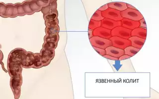 Медикаментозное лечение колита кишечника