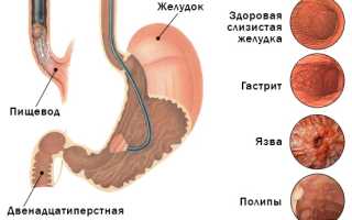 ФГДС при гастрите, заключение и видео