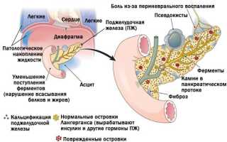 Синдромы хронического панкреатита