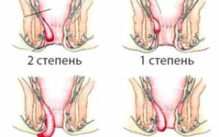 Очень сильный геморрой после родов