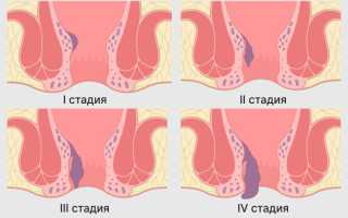 Симптомы (признаки) геморроя при беременности