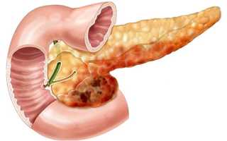 Реактивная поджелудочная железа – изменения состояния