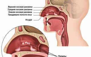 Причины возникновения полипов и развитие полипоза